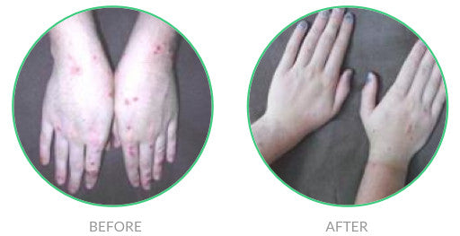 Eczema relief in 20 days