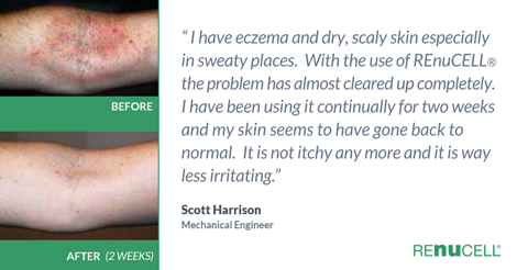 Eczema and dry skin in sweaty places.