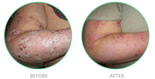 Healing Severe Psoriasis